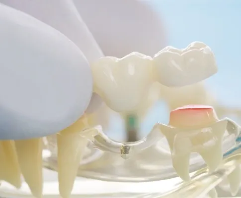 Are Dental Bridges Comfortable