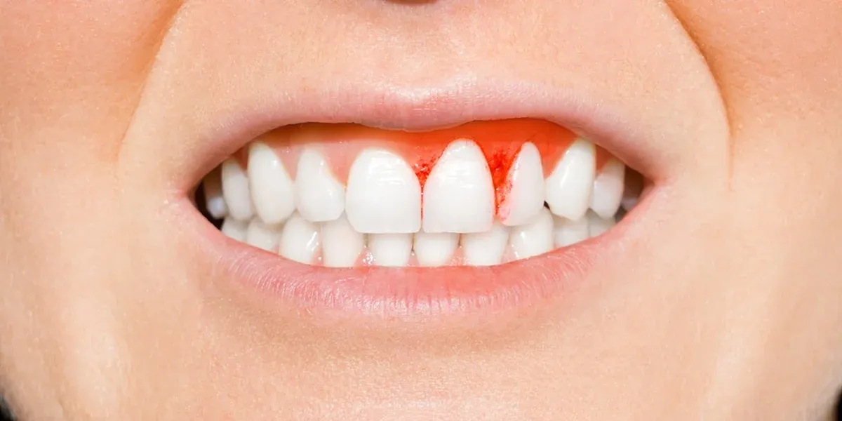 Can Dental Implants Help with Periodontal Disease