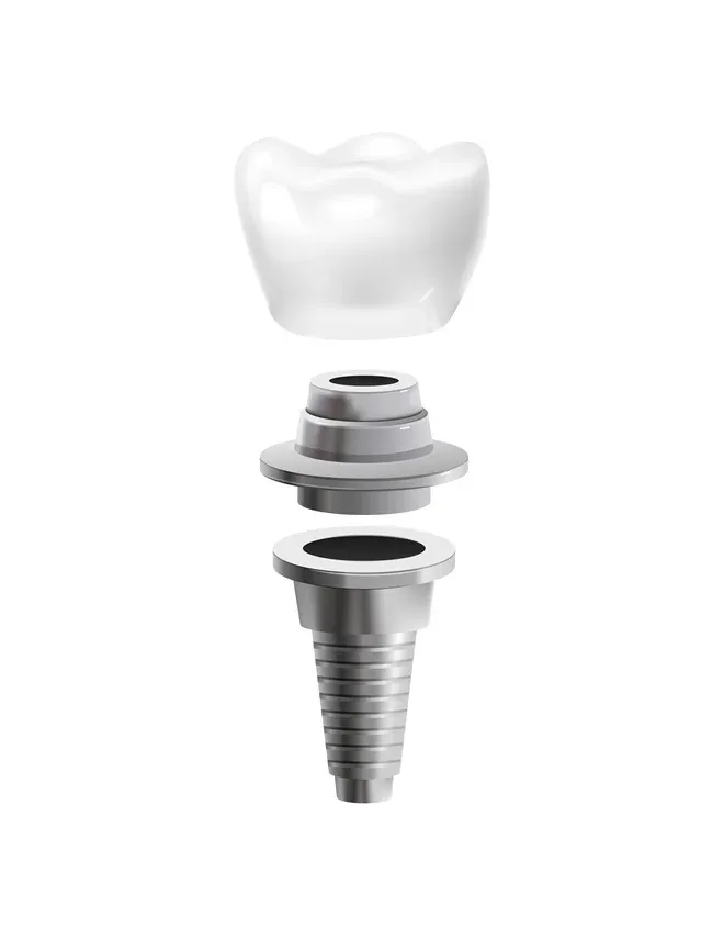 Can Dental Implants Help with Periodontal Disease