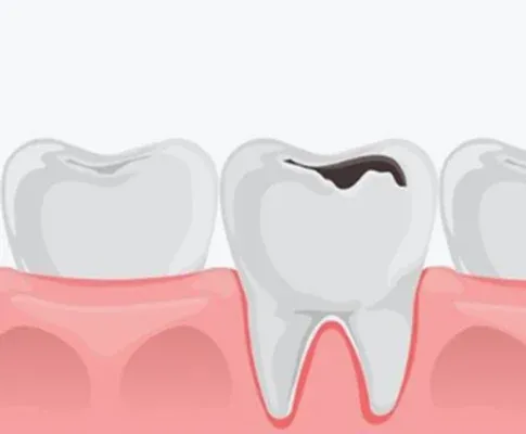 Dental Crowns and Dental Bridges