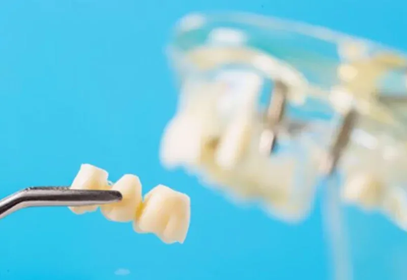 Dental Crowns and Dental Bridges