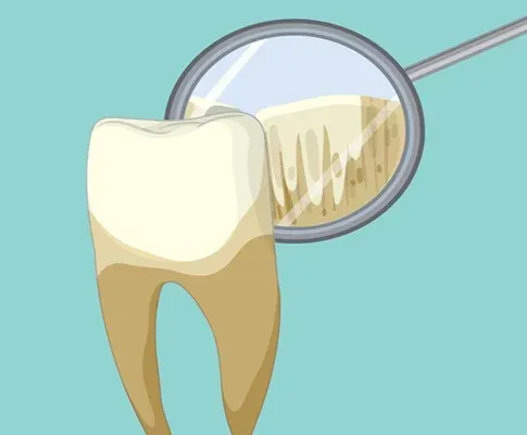 Gum Disease & Dental Implants