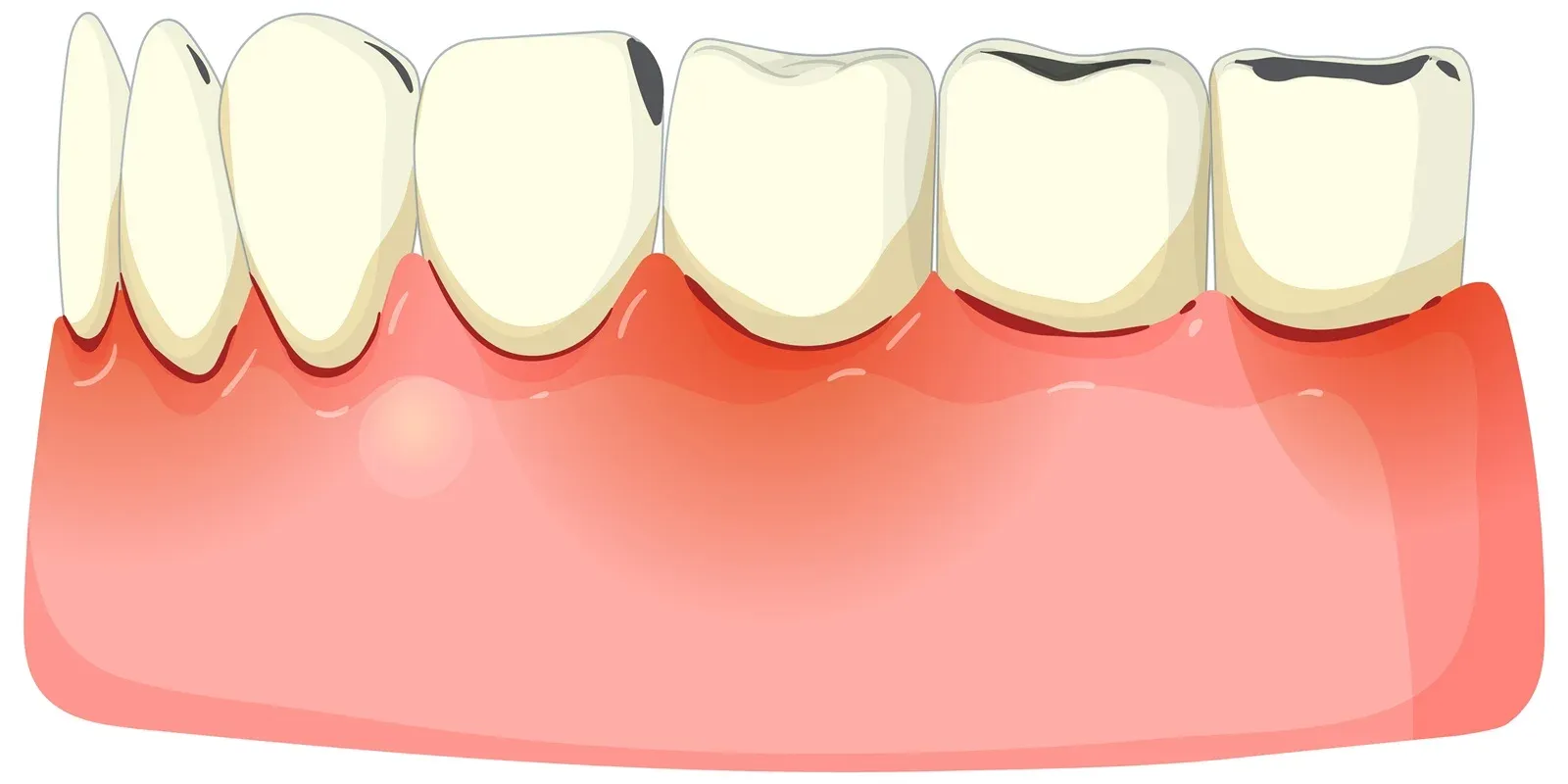 Gum Disease & Dental Implants